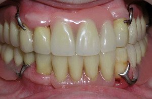 Бюгельные зубные протезы отзывы