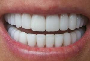 Реставрация передних зубов: «до» и «после»