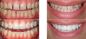 Реставрация зубов очень нужна во многих случаях.