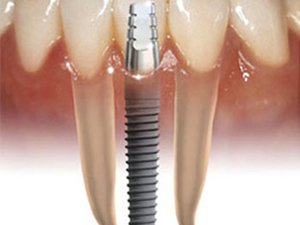 Описание основных видов имплантатов зубов