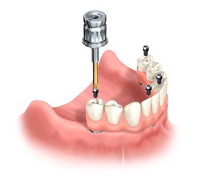 Зубные штифты: особенности установки в стоматологии