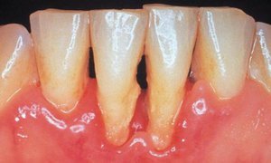 Противопоказания к применению нейлоновых зубных протезов