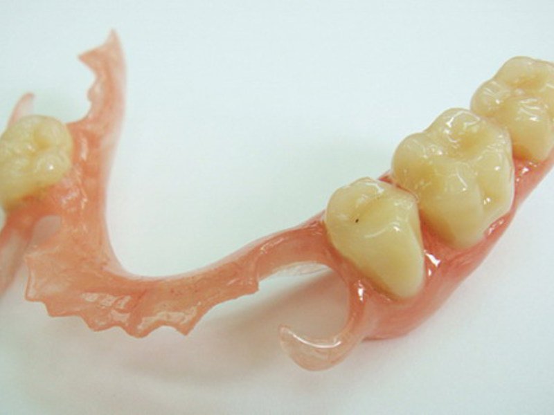 Частичное протезирование зубов нейлоновым протезом