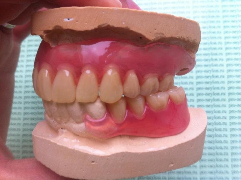 Виды нейлоновых зубных протезов