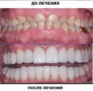 Применение виниров для улучшения внешнего вида зубов