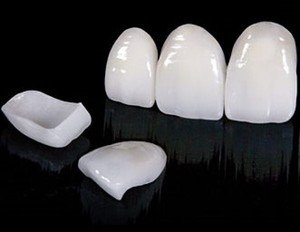 Виниры на зубы: фото до и после