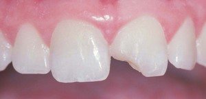 Преимущества и недостатки наращивания зубов