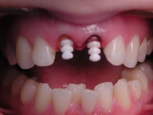 Противопоказания к наращиванию зубов