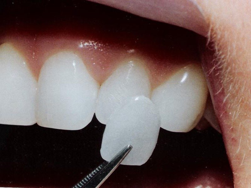 Как происходит наращивание зубов