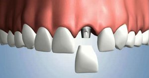 Имплантация зубов под ключ: особенности, преимущества, цены