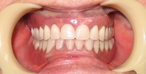 Использование зубных протезов отзывы