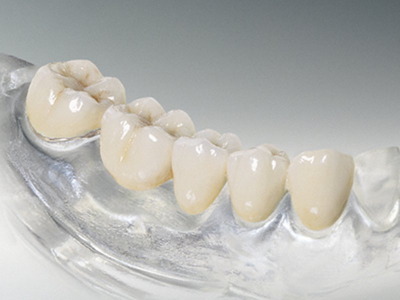 Преимущества силиконовых зубных протезов