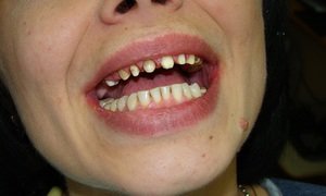 Установка металлокерамической коронки на передний зуб