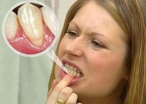 Образование на зубах -зубные камни 