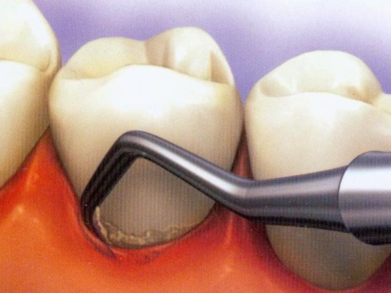 Зубной камень и причины его появления