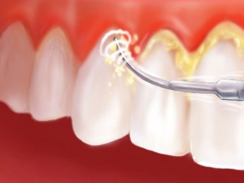 Устранение проблемы с зубными камнями