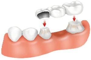 конструкции несъемных зубных протезов