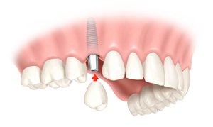 Коронки устанавливают, если зуб сильно поврежден.