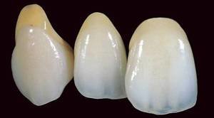 Коронки из металлокерамики выглядят как натуральные зубы.
