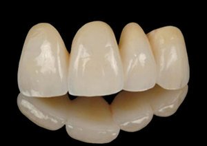 Керамические коронки наиболее похожи на натуральные зубы.