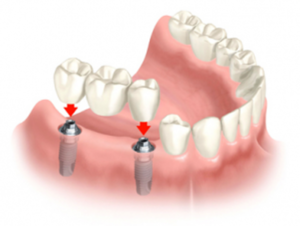 Мостовидный протез - это распространенное решение в стоматологии.