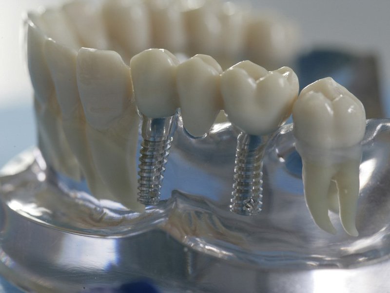 Характеристика конических зубных винтов