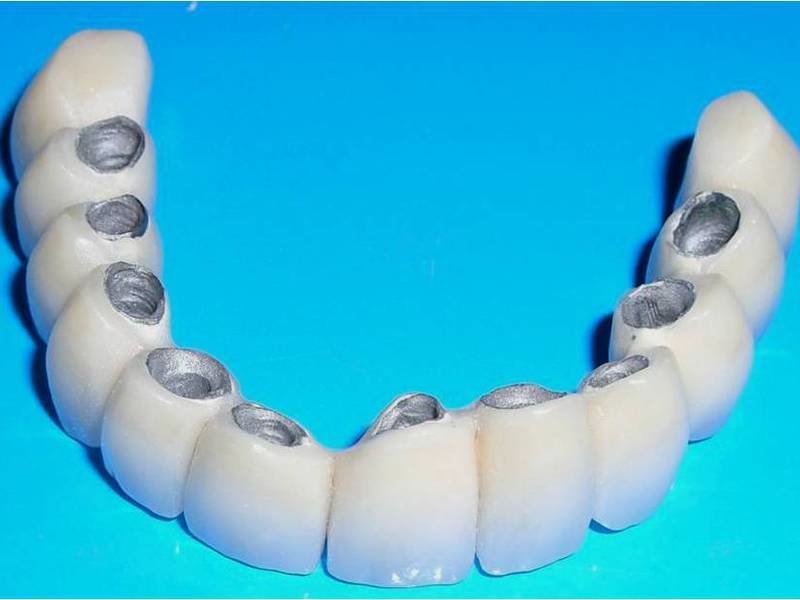 Описание лучшего выбора зубов для установки