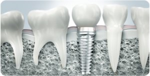 Стоимость зубных имплантов