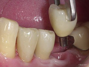 Частичное протезирование зубов