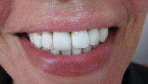 Металлокерамика на передние зубы – каковы отзывы пациентов?