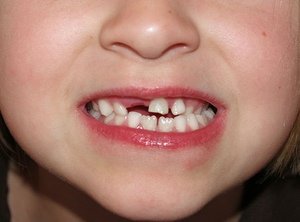 Причина выпадения зубов раньше времени