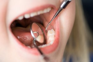 Этап серебрения зубов