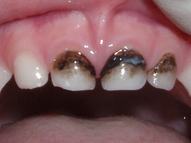 Способ лечение зубов у детей