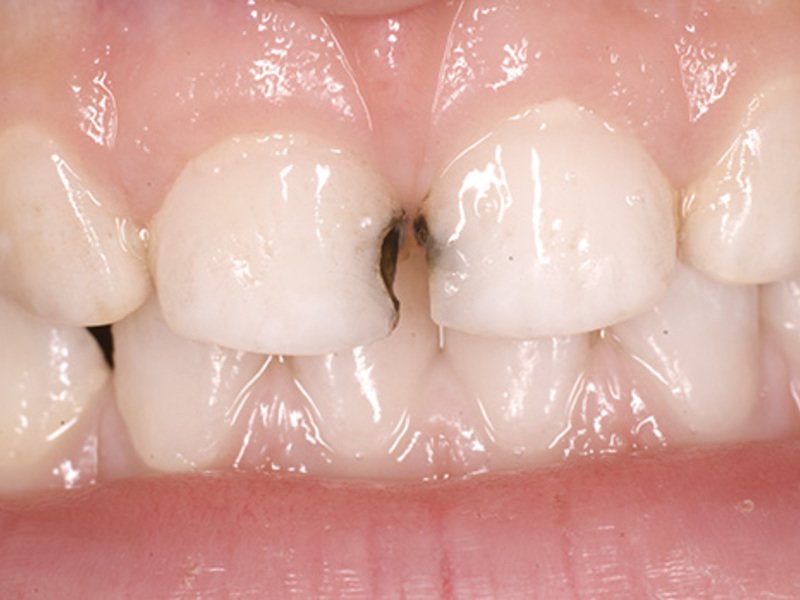 Как выглядят зубы после серебрения