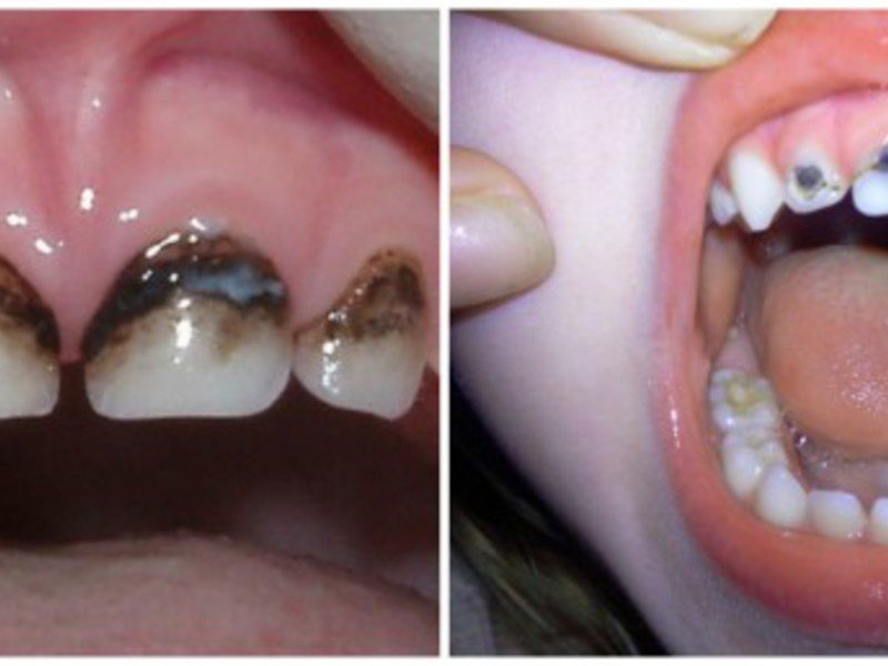 Как отбелить зубы у детей