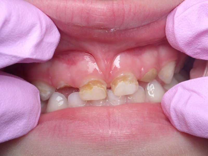 Молочные зубы у детей их проблемы
