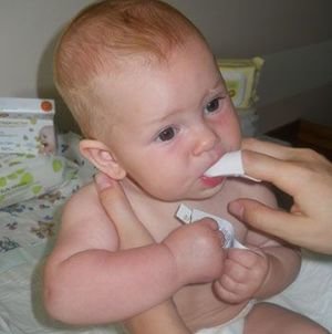 Лечение молочницы у детей