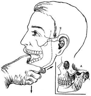 Как происходит вправление нижней челюсти