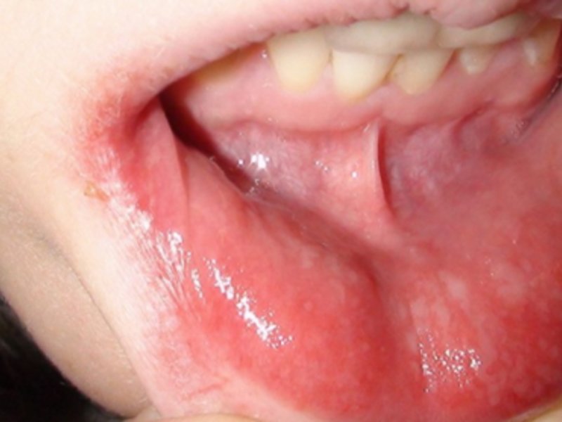 Симптомы аллергического стоматит у детей