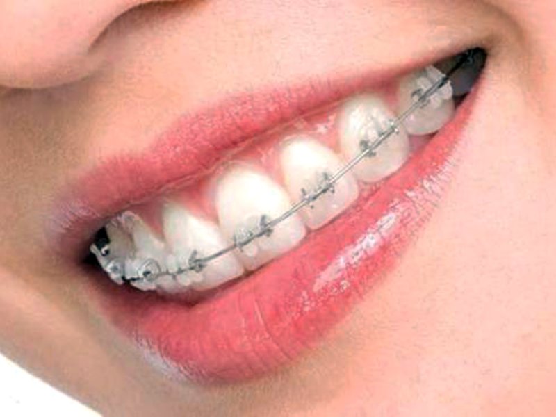 Выравнивание зубов с помощью брекетов