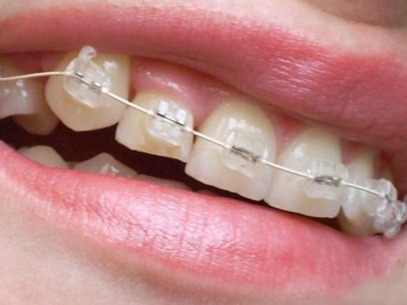 Прозрачные брекеты на зубах