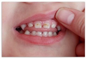Кариес на зубах ребенка возникает очень часто