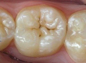 Так выглядят фиссуры зуба, которые становятся часто источниками кариеса.