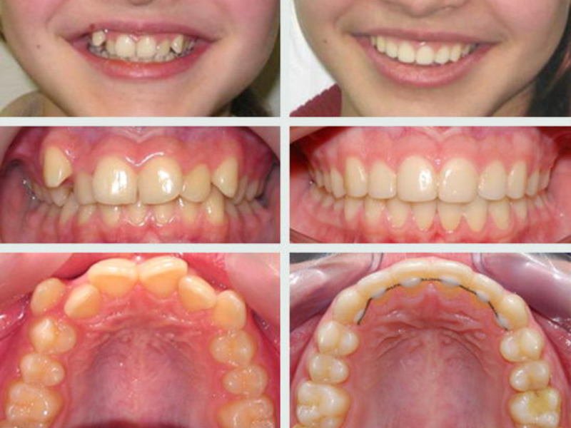 Зубы у ребенка после брекетов