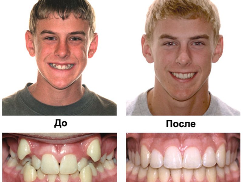 Результат выравнивания зубов брекетами