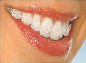 Способы выровнивания зубов