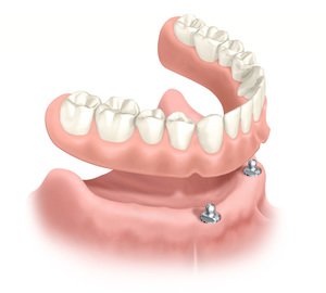 Описание способов крепления зубных протезов