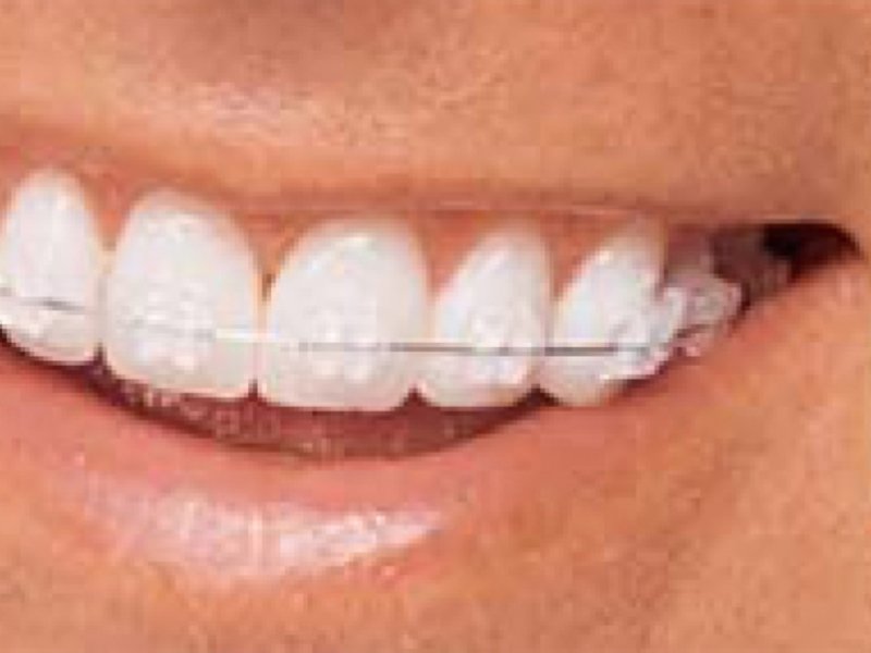 Невидимые брекеты на зубы