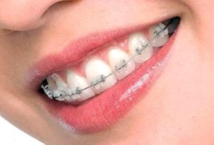 Брекеты на зубах выглядят аккуратно