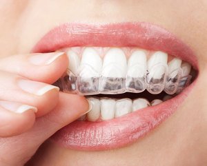Чем полезны пластинки для выравнивания зубов